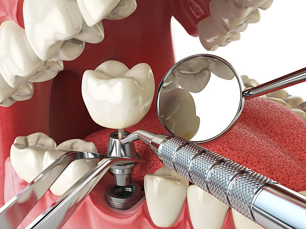 Best Emergency Root Canal Treatment in Seis Lagos, TX